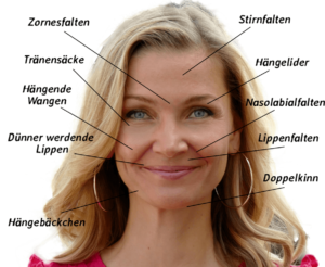 Falten, die sich mit einem Minifacelift beheben lassen